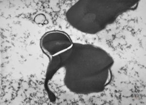 M,49y. | blood - dyserythropoetic anemia M,49y. | blood - dyserythropoetic anemia